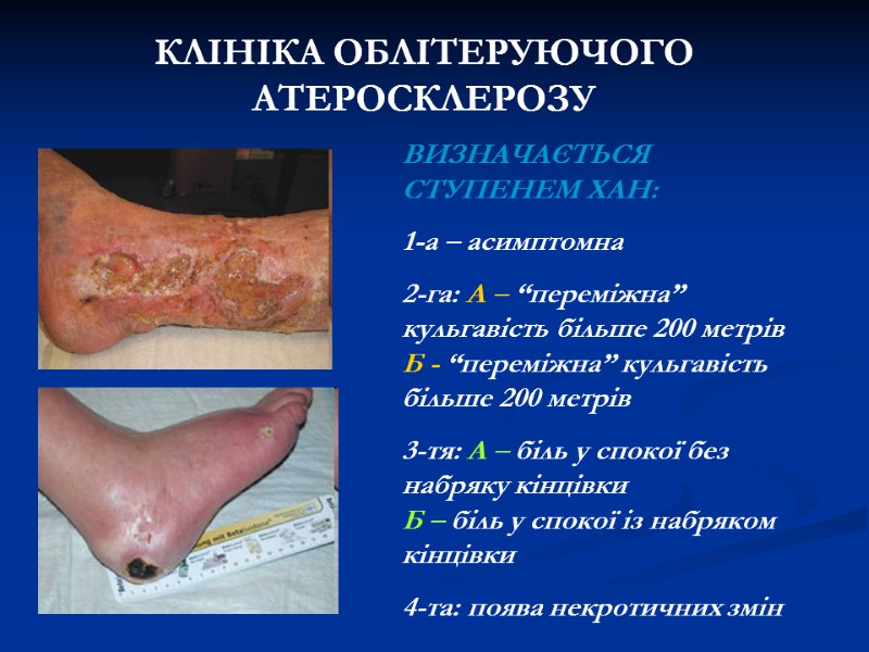 КЛІНІКА ОБЛІТЕРУЮЧОГО АТЕРОСКЛЕРОЗУ ВИЗНАЧАЄТЬСЯ СТУПЕНЕМ ХАН: 1-а – асимптомна 2-га: А КЛІНІКА ОБЛІТЕРУЮЧОГО АТЕРОСКЛЕРОЗУ ВИЗНАЧАЄТЬСЯ СТУПЕНЕМ ХАН: 1-а – асимптомна 2-га: А